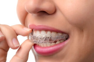 Invisible Braces cost in Summerlin