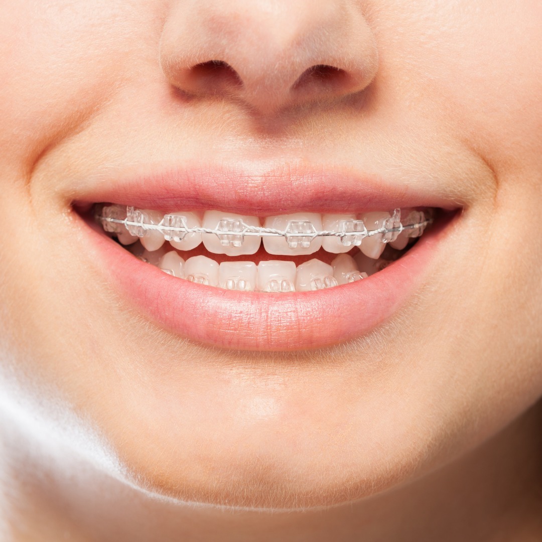 Invisalign alternative Summerlin